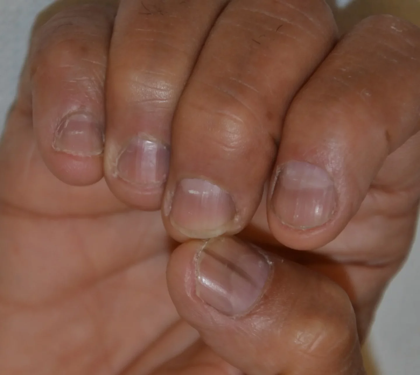 Fig. 3 Melanonichia di diverse unghie, da trauma, in onicofagia.