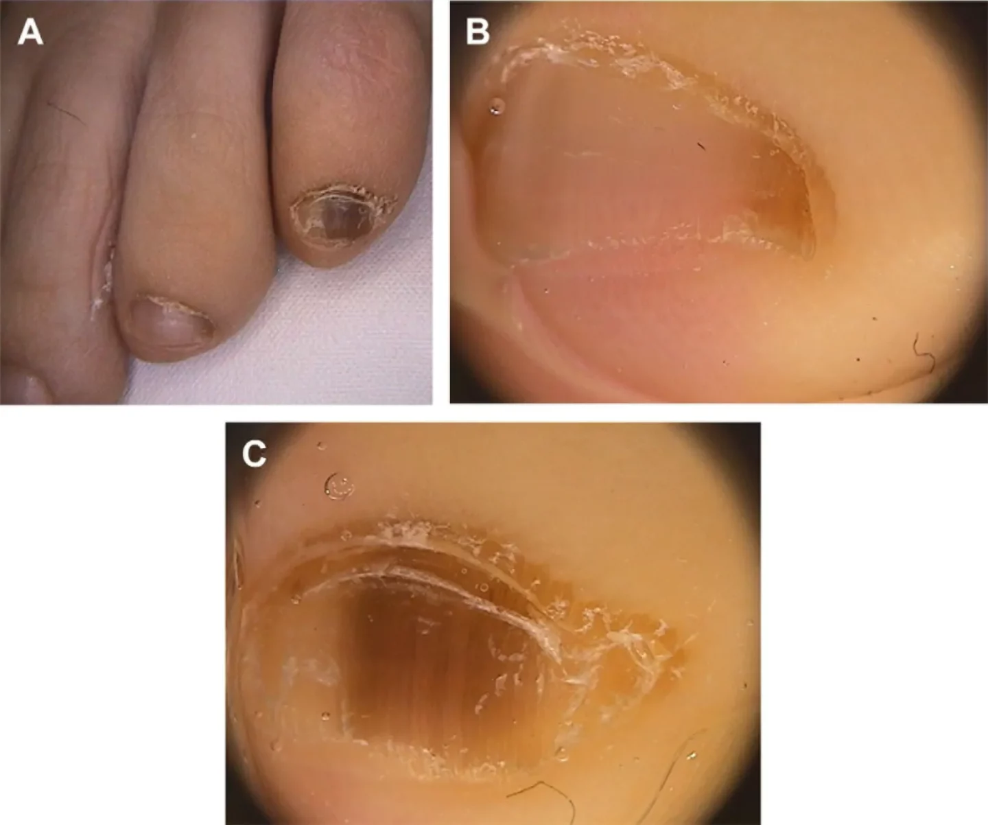 Fig. 4 Melanonichia del IV e V dito, da frizione delle calzature. L’osservazione col dermatoscopio permette di vedere a elevato ingrandimento le 2 bande pigmentate.