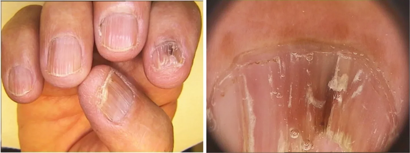 Fig.5 Melanonichia del II dito da attivazione dei melanociti per l’infiammazione delle matrice ungueale associata a lichen planus delle unghie.