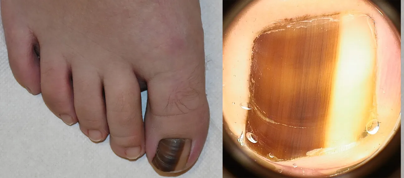 Fig. 6. Nevo della matrice ungueale in un bambino di 10 anni. La pigmentazione bruno scura interessa i 2/3 dell’unghia e si estende alla piega ungueale prossimale. La dermatoscopia mostra un colore di fondo marrone e nero dell'unghia, bordo irregolare e linee che cambiano larghezza e colore lungo la lunghezza. Questi parametri in un adulto sarebbero indicativi della necessità di un'asportazione chirurgica.