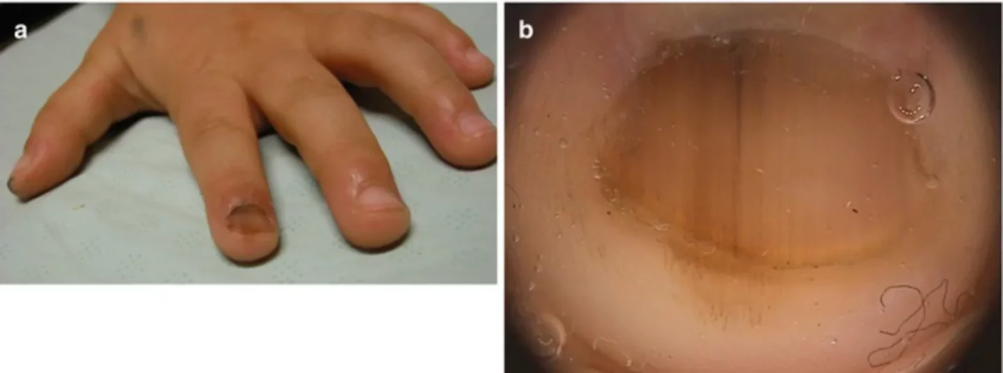 Fig. 7. Nevo della matrice ungueale in una bambina di 5 anni. Pigmentazione marrone irregolare dell'intera lamina ungueale e dell'iponichio. La dermatoscopia mostra un colore di fondo marrone irregolare dell'unghia, con linee che cambiano larghezza e colore lungo la lunghezza. È evidente anche la pigmentazione melanica dell'iponichio.