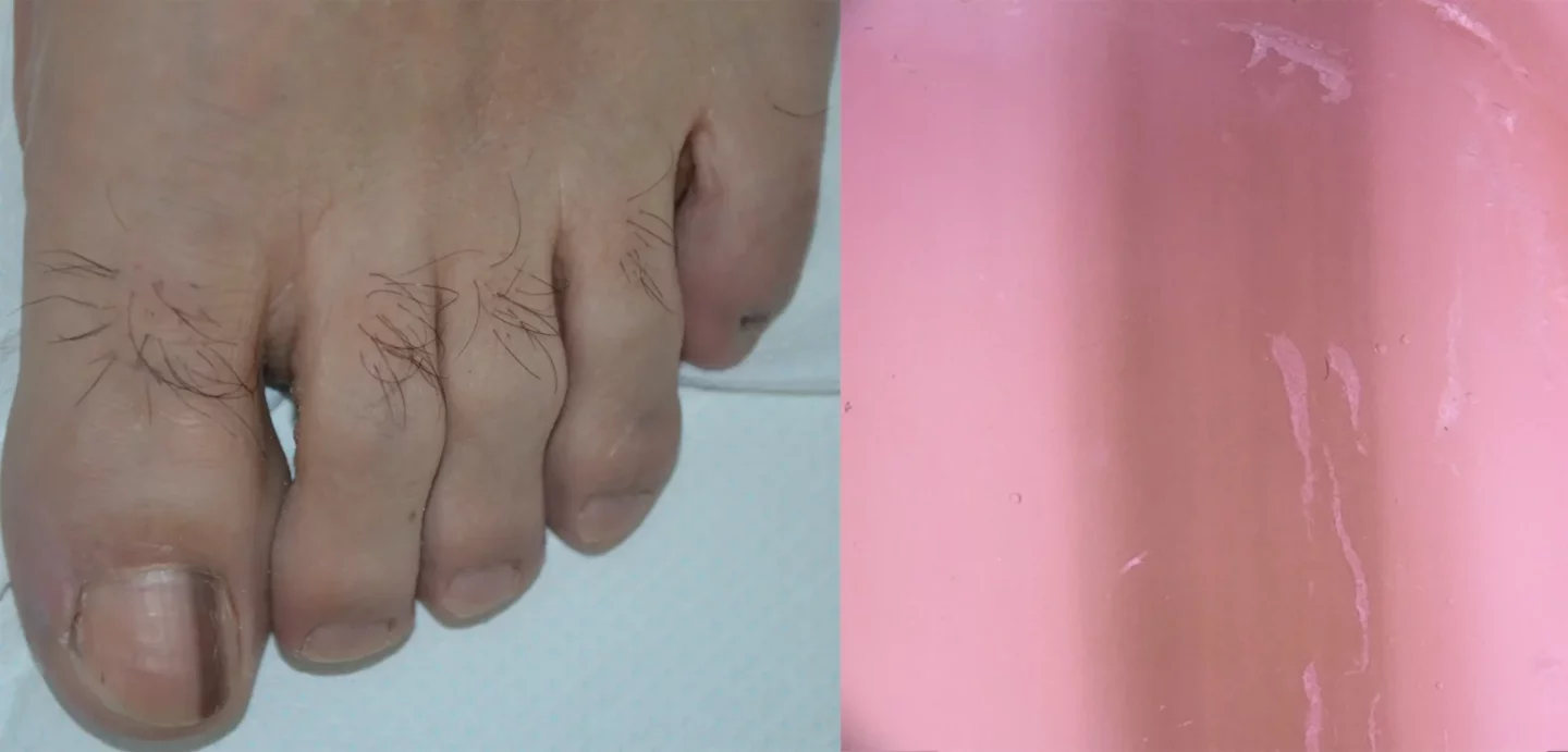 Fig. 9. Melanoma dell’unghia in un uomo di 64 anni. Banda longitudinale di colore marrone-nero di 4 mm di larghezza. La dermatoscopia mostra un colore di fondo marrone, con linee difficilmente distinguibile per la scarsa trasparenza dell’unghia. 