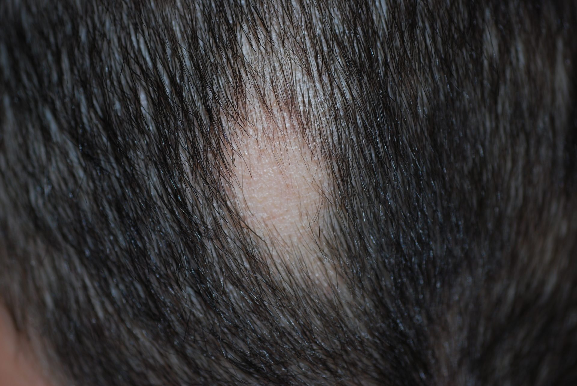 Alopecia areata
