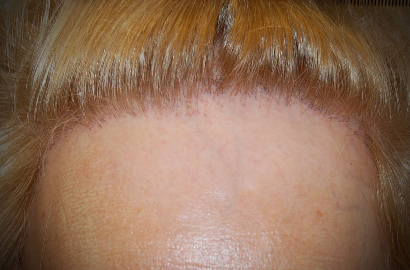 L’alopecia fibrosante frontale: una malattia di sempre piu frequente osservazione