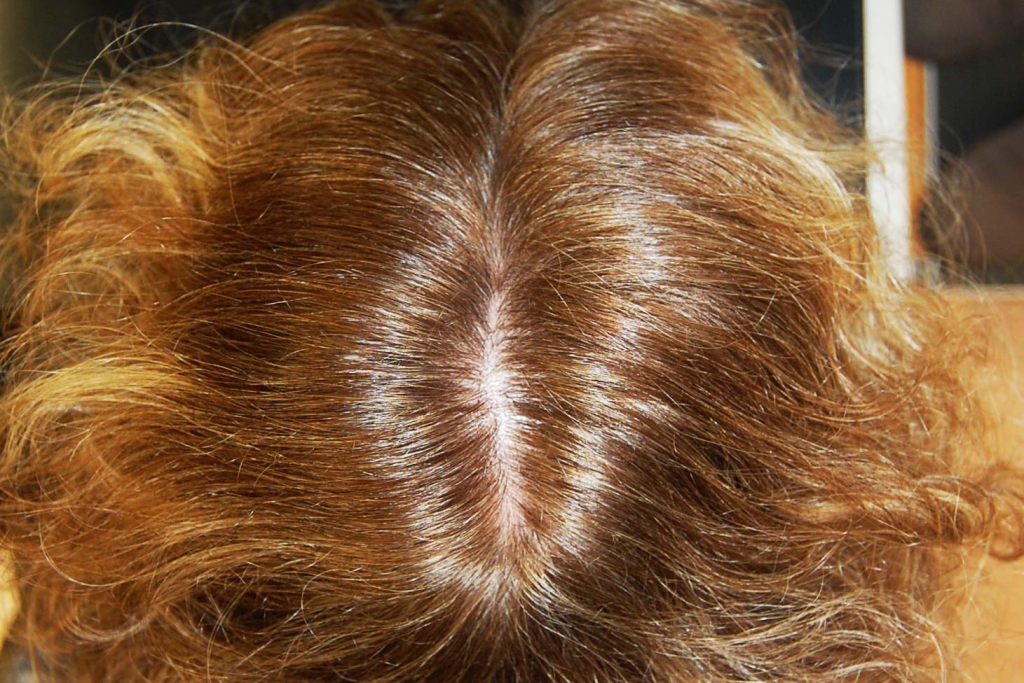 La caduta dei capelli nella donna, telogen effluvium e alopecia androgenetica femminile