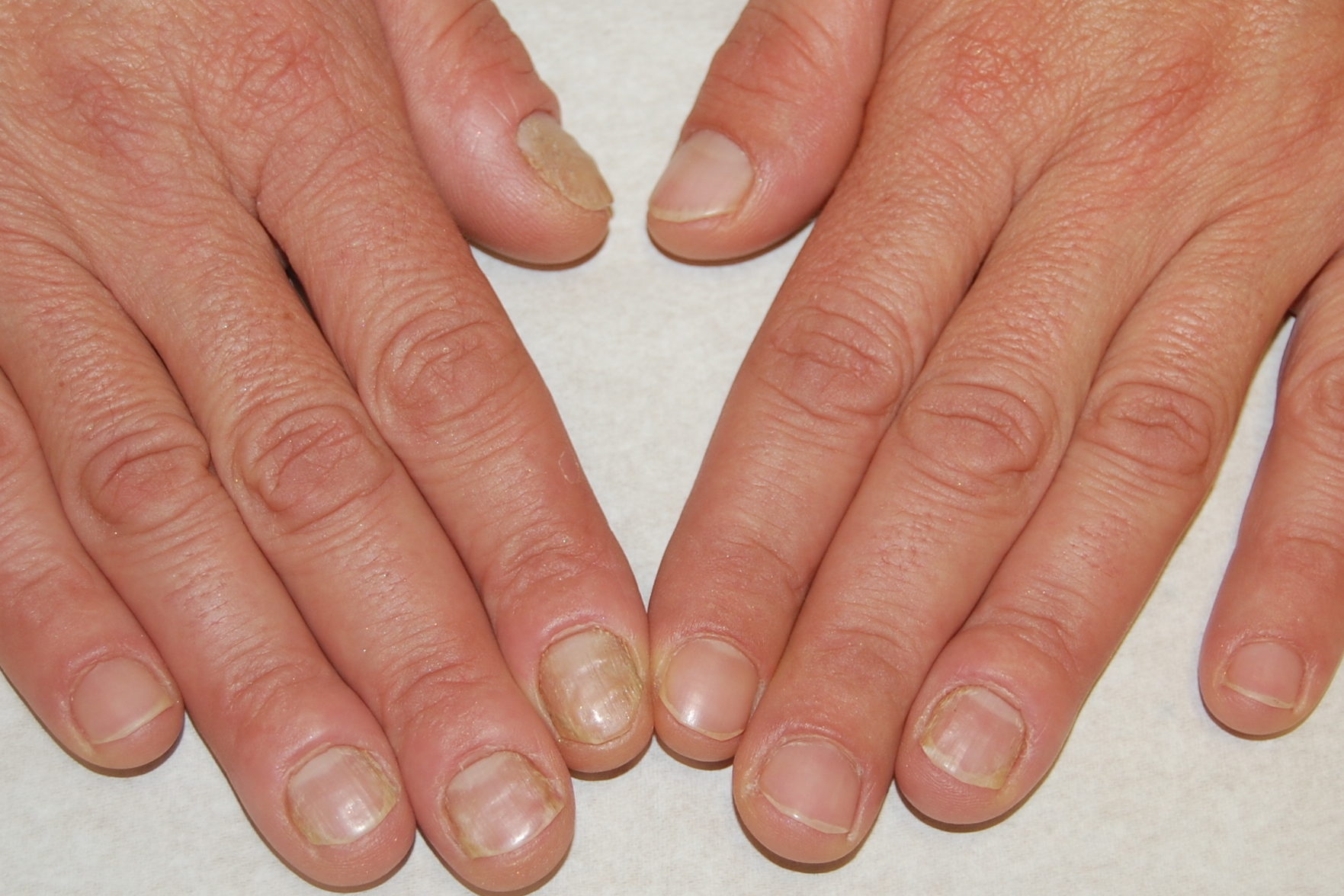 Malattie delle unghie delle mani