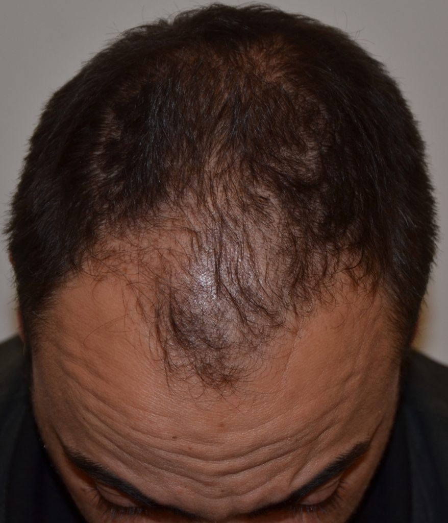 Alopecia Androgenetica: come riconoscerla e come curarla