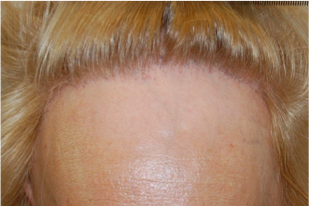 Caduta dei capelli nella donna: nuove malattie e nuove terapie.